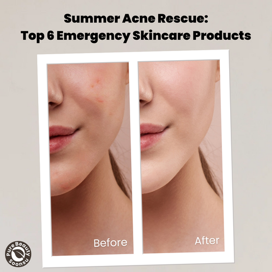 Summer Acne Rescue: Top 6 Emergency Skincare Products