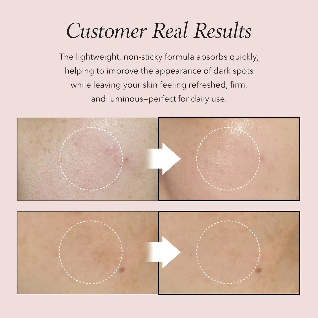Before and after skin treatment showing dark spots reduction on a beige background.