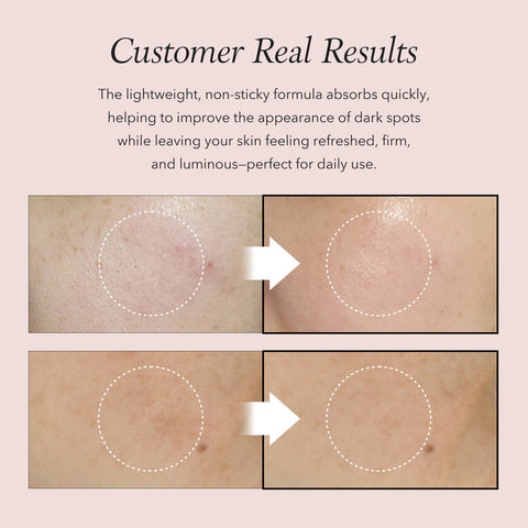 Before and after skin treatment showing dark spots reduction on a beige background.