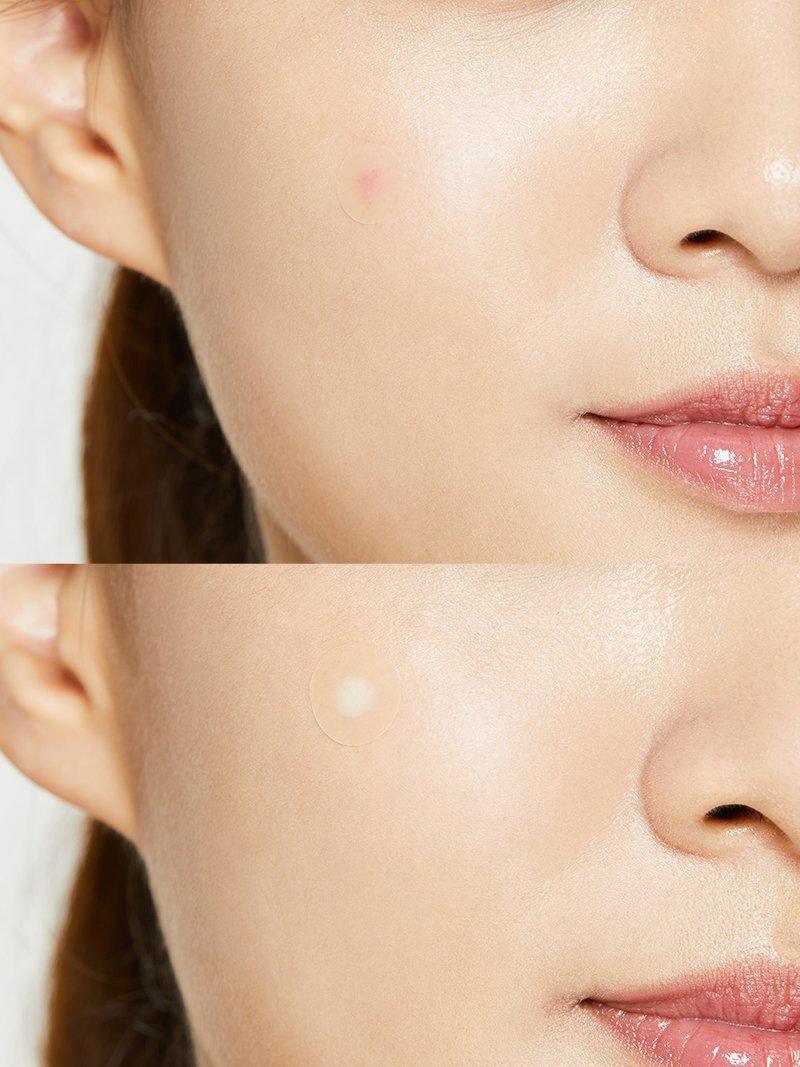 Soonsu Beauty Acne Pimple Master Patch 24patches side view