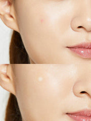 Soonsu Beauty Acne Pimple Master Patch 24patches side view