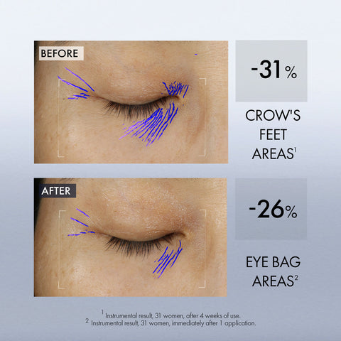 Before and after comparison of crow's feet and eye bags with statistical reductions.